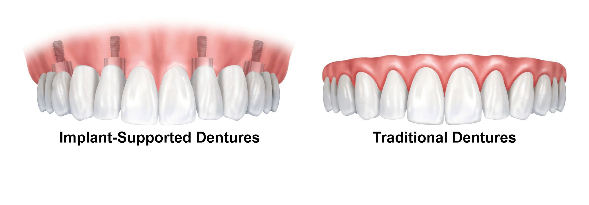 implant denture