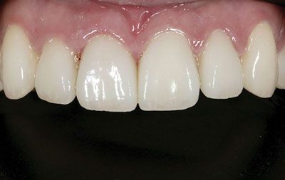 After teeth whitening using biomimetic dentistry techniques