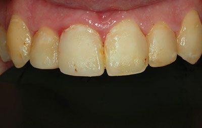 Before teeth whitening