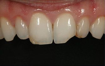 Before dental bonding photo